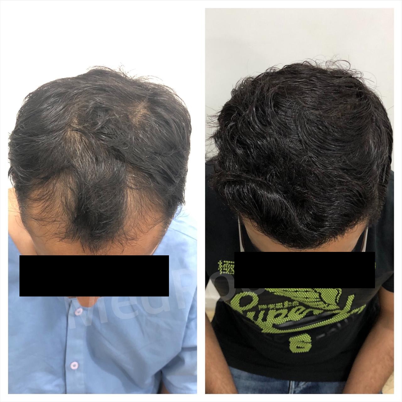 Best hair transplant doctor in delhi